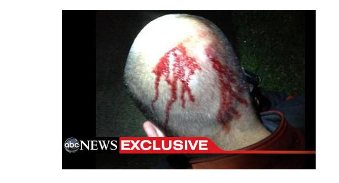 After inciting anger and strife March 28 by claiming Zimmerman had no head wounds, ABC published this photo 3 weeks later showing the opposite